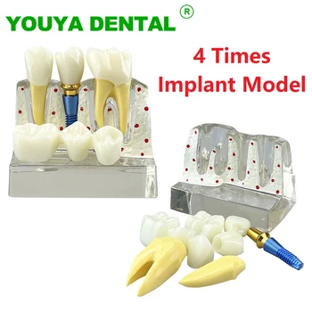 Dantų Implantai Mokymo Modelis 4 Kartus Implantas Analizė Karūna Tiltas Dantų Modelio Stomatologas Demonstravimo Pavyzdys Mokymo Studijų